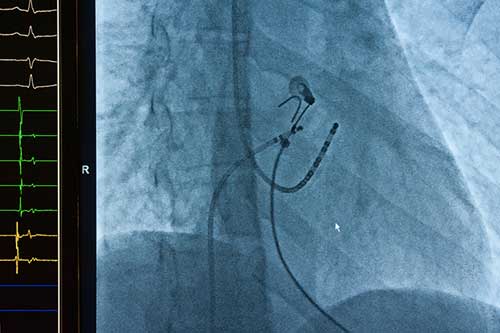 Cardiac ablation medical monitor