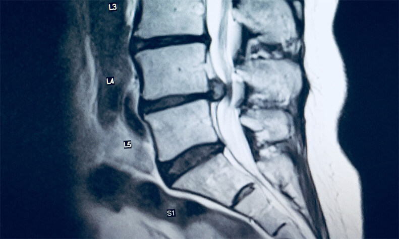 Cauda Equina Syndrome MRI image of spine