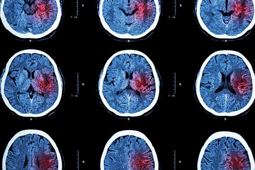 Medical imaging showing stroke